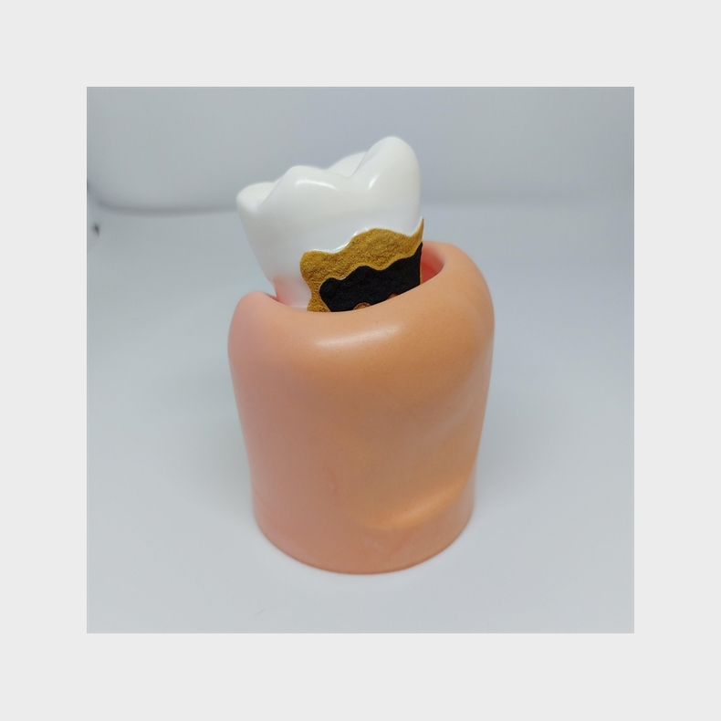 Stor Parodontitis Studiemodel 